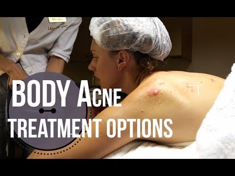 Body Acne Treatment Options : What To Ask For At A Med Spa