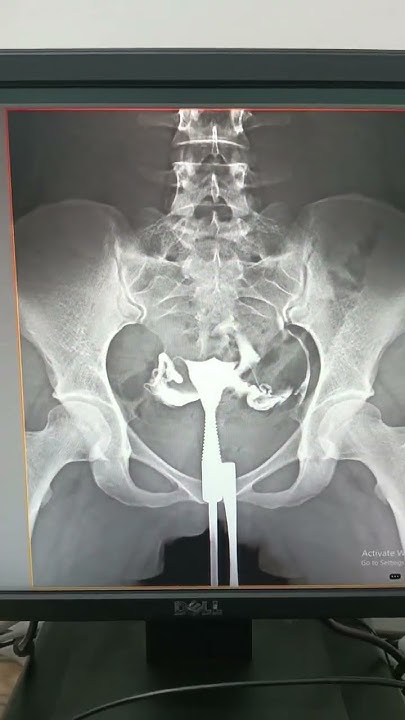 it-s-a-normal-hsg-both-fallopian-tubes-are-clearly-opacified-youtube