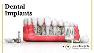 Dental Implants are the Long-Term Solution to Missing Teeth