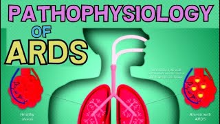 ACUTE RESPIRATORY DISTRESS SYNDROME (ARDS) - PATHOPHYSIOLOGY