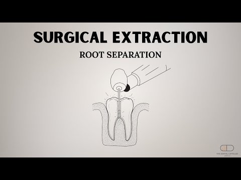 Root Separation in Extractions: When to Do It, How to Do It, and Clinical Tips