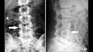 262 Hz : Spine Lumbar L4 (RIFE Healing Frequency)