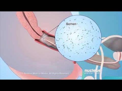 Video: Ako zabrániť opakovaniu bakteriálnej vaginózy: 14 krokov