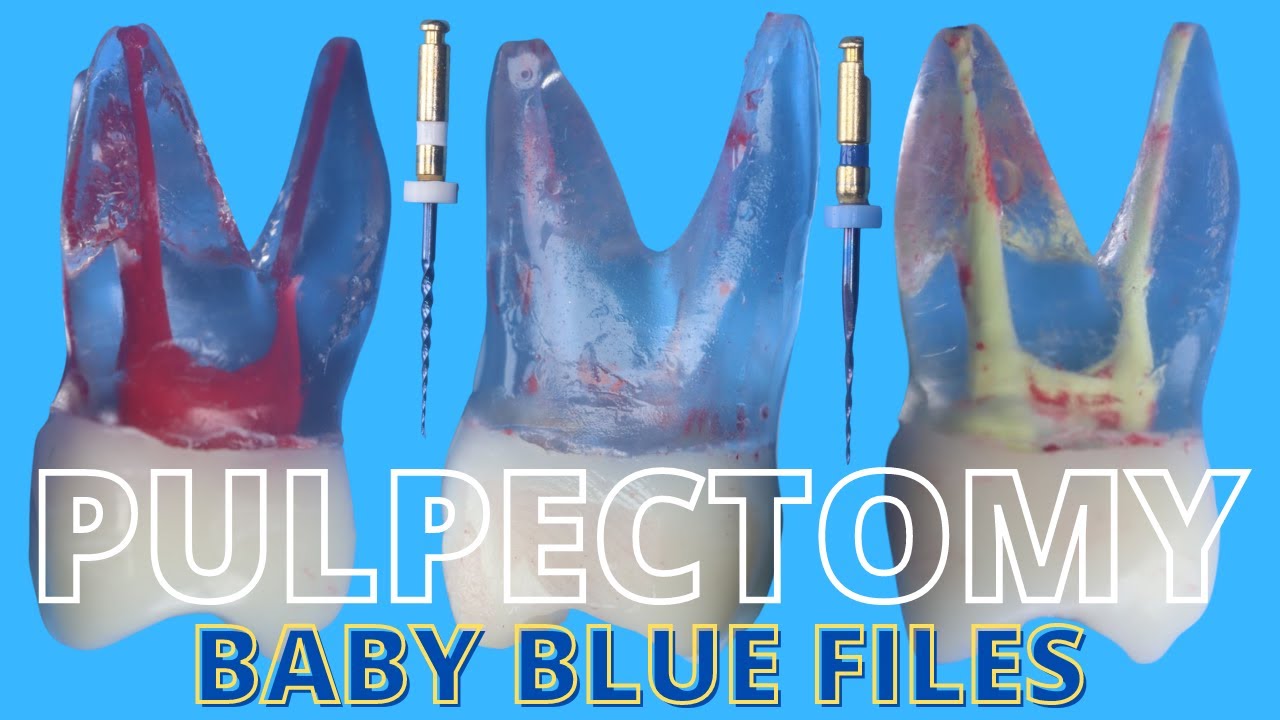 Pulpectomy ⚪️ Baby Blue (Pediatric Rotary Endodontic Files) 🔵 Simulated
