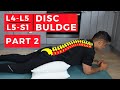 l4 l5 l5 s1 disc bulge treatment