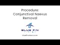 Conjunctival Naevus Removal - 3 #bluefinvision #conjunctivalnaevusremoval #londoneyecare