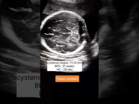 #baby #ultrasound #pregnancyscan #pregnant #lifeisbutadream #babyultrasound #babygirl #ihavethisthin by @Fazalhaq Radiology