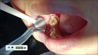 Wow teeth cleaning by dental, تنظيف الأسنان  #teeth #dental #dentist by Dr Yayayue (牙牙月姐) 21 views 4 months ago 2 minutes, 55 seconds
