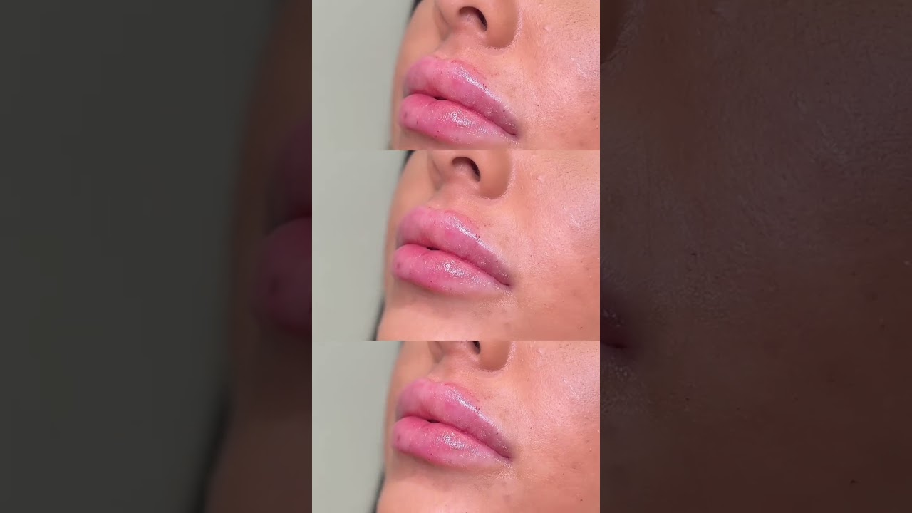 Juvederm Ultra Lip Filler 👄💉 Before and After
