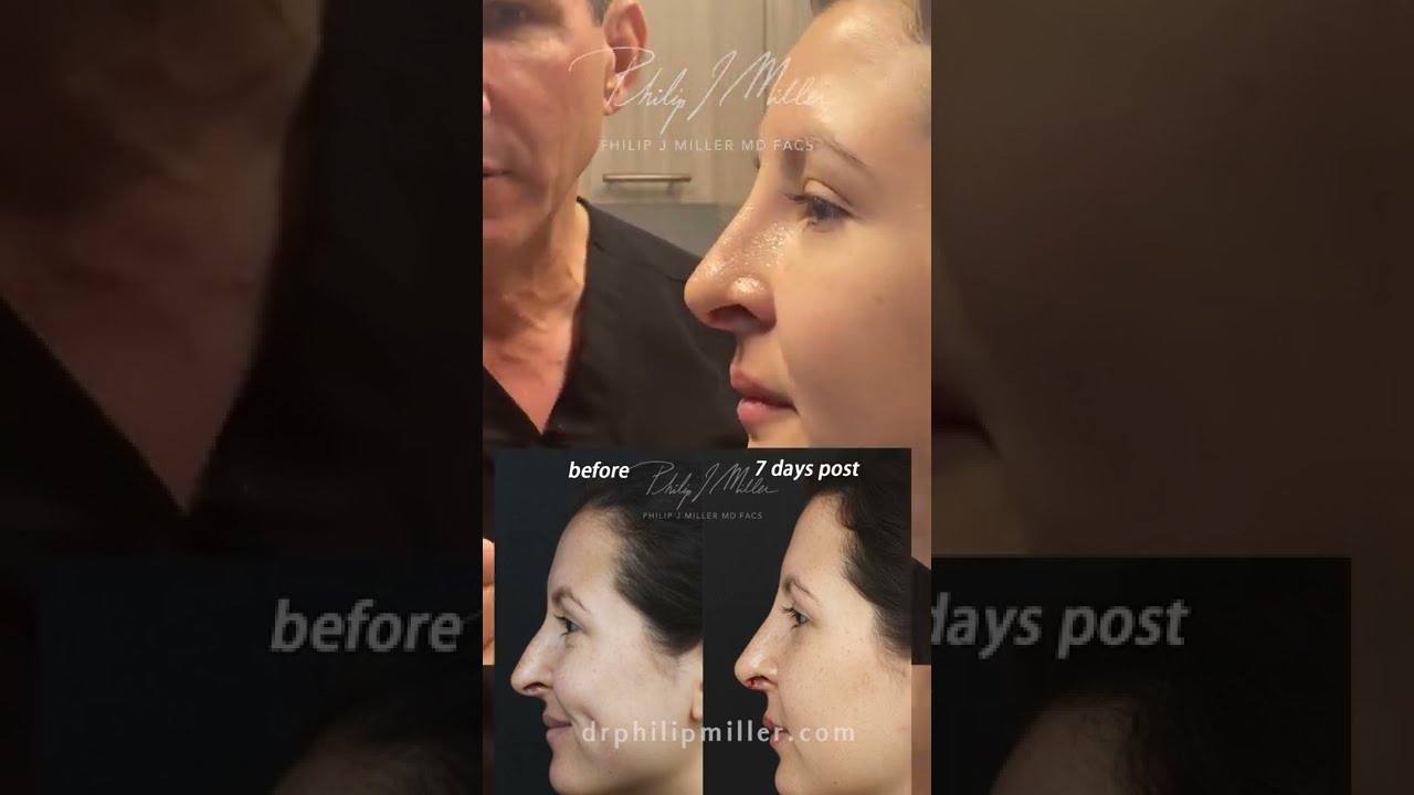 One Week Post Rhinoplasty, A Very Happy NYC Patient Shares Her Story