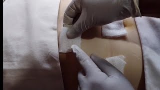 colecistectomia Laparoscópica | Curación