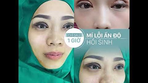 Hồi sinh mí lỗi ✅ Viện thẩm mỹ D