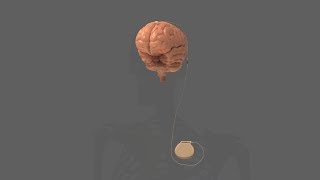 Deep Brain Stimulation Device With SYGNUS System by BalSealEngineering 202 views 5 years ago 1 minute, 13 seconds