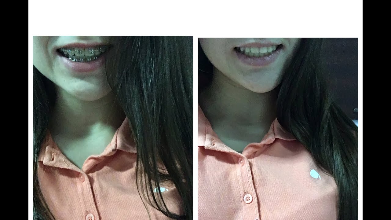 МНЕ СНИМАЮТ БРЕКЕТЫ?!БОЛЬ?!ЦЕНА?!