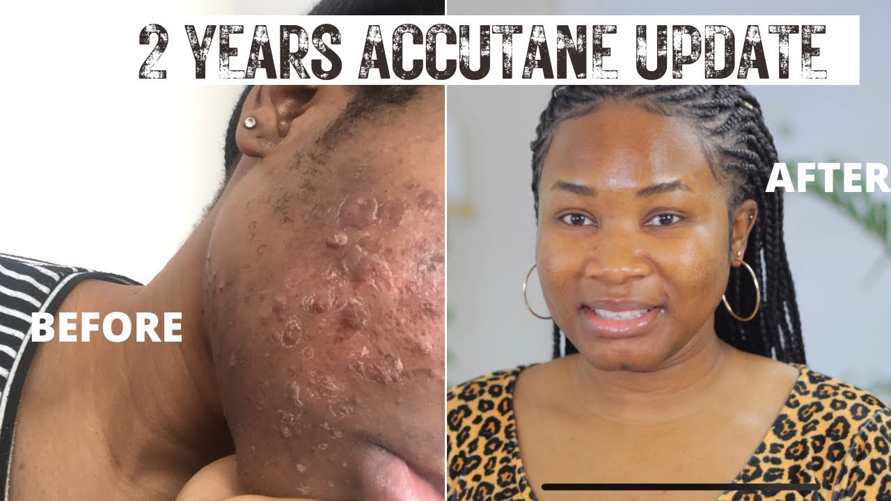 2 Years after Accutane Update 2022 Relapse, Hyperpigmentation, etc