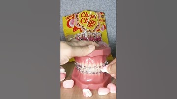 Mang mắc cài thì ăn kẹo được không?Dr Ngọc Yến #niengrangmaccai #niềng_răng