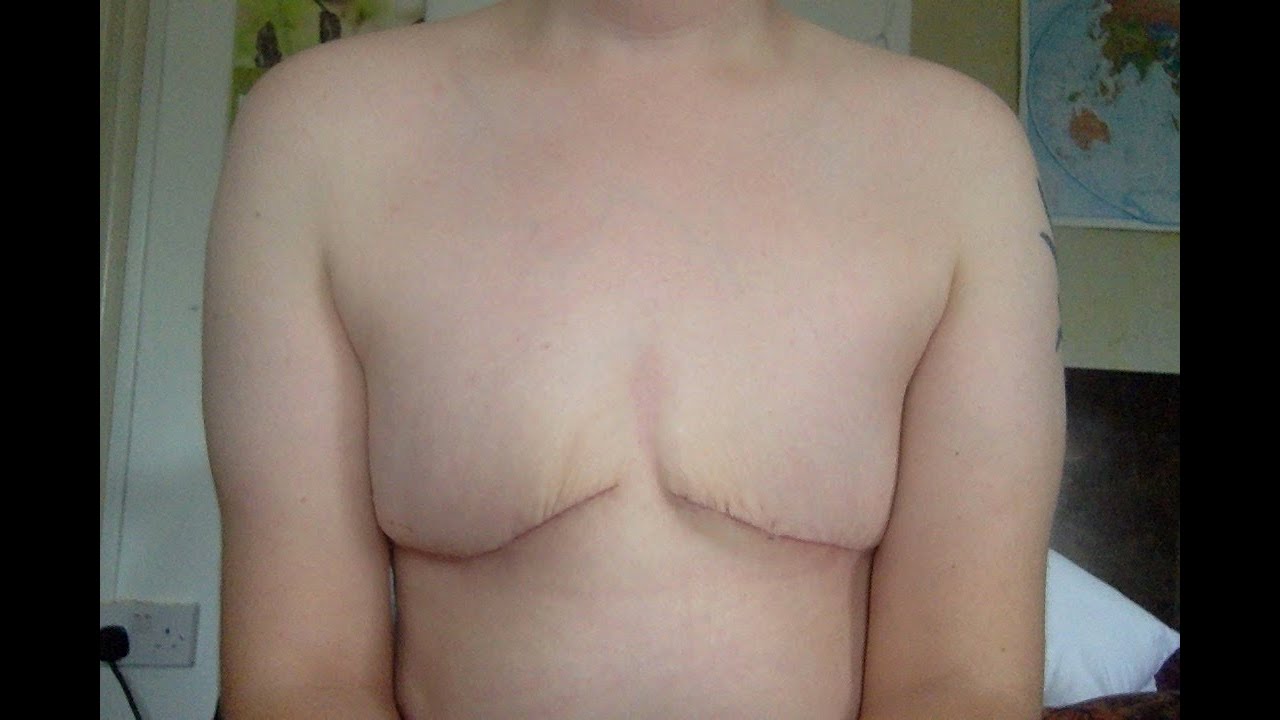 WHAT HAPPENED TO MY NIPPLES??? + top surgery revision update 