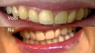 Dorien Anti Ageing Center Druten  - behandeling 1 - Tanden Bleken