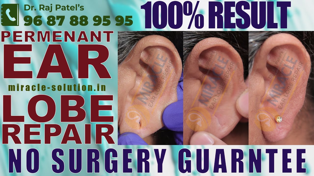 Восстановление мочки уха: Что делать, если отверстие в мочке уха большое/прорезано серьгой? Следу...