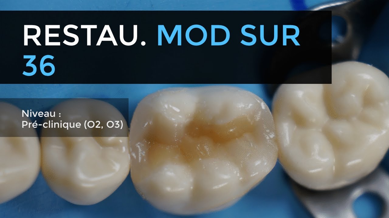 105 - Restauration MOD en résine composite sur molaire mandibulaire