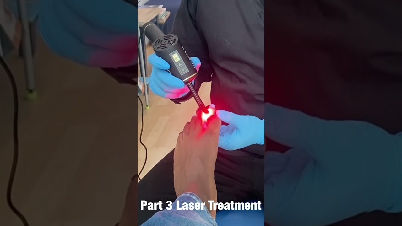 Toenail fungus laser treatment