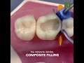 Composite fillings at the krisalys dental