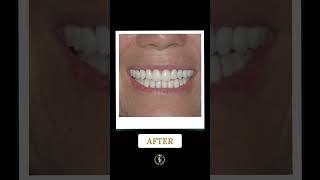 #fullmouthdentalimplants #smiletransformation #beforeandafter