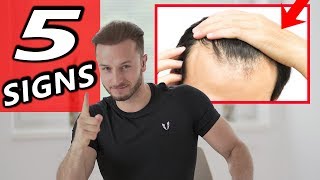 5 Early Signs of Balding + 3 Tips to prevent it NOW!
