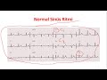 Temel EKG  Elektrokardiyografi  II