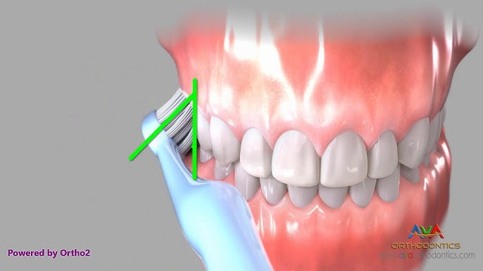 Orthodontic Expander or Spacer - Lower Schwartz Appliance 