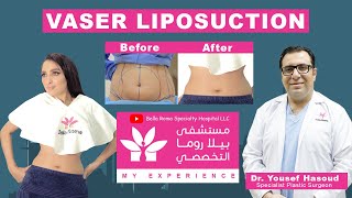 Body Shaping with Vaser Liposuction | Bella Roma Hospital | Dr. Yousef Hasoud