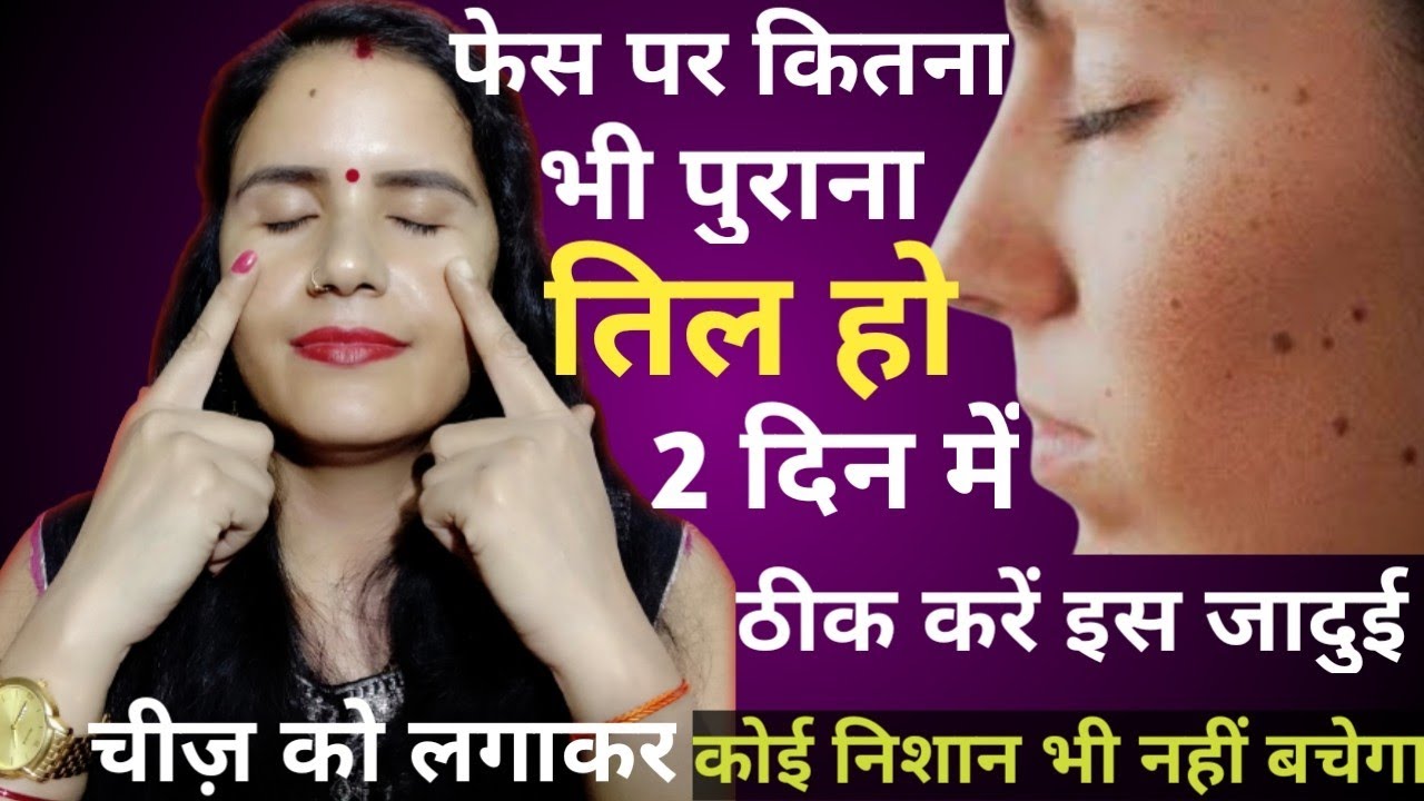 फेस के तिल को 2 दिन में कैसे ठीक करें 🤔 Chehre Ke Til Kaise Hataye