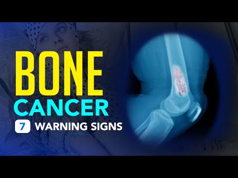 Bone Cancer - 7 Warning Signs