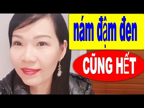 Nám tàn nhang sẽ trị với chanh như thế nào?bí quyết làm đẹp || my le australia #6