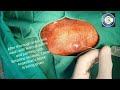 Implant removal humerus  retrograde enders nail humerus removal  enders nail removal  adamya h