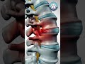 Maigne Syndrome