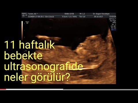 11. gebelik haftasında ultrasonografi - bebeğe ait yapıların gözlemlenmesi (anlatımlı)