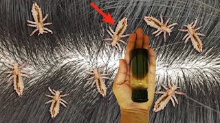 सर की जुएं और लिखें हटाने का जबरदस्त उपाय | Sir Me Ju Ka ilaj | Head Lice Removal & Nits in Hair