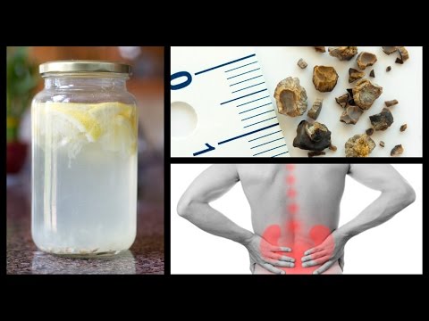 Natural Home Remedies For Kidney Stones