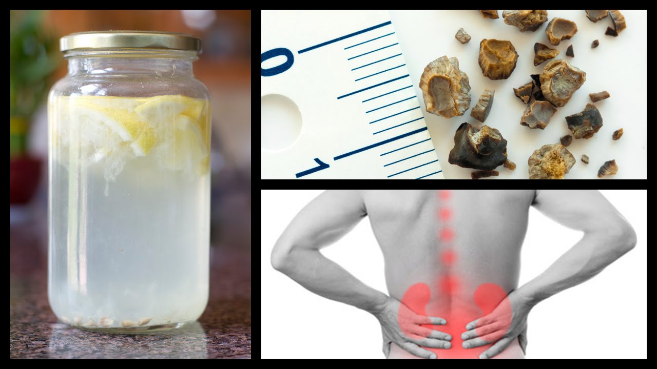 Natural Home Remedies for Kidney Stones - YouTube