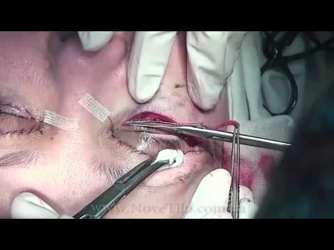 Блефаропластика в 3 х минутах | Eyelid plastic surgery in 3 minutes Блефаропластика в 3 х минутах | Eyelid plastic surgery in 3 minutes