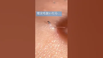 毛を抜いただけなのに 