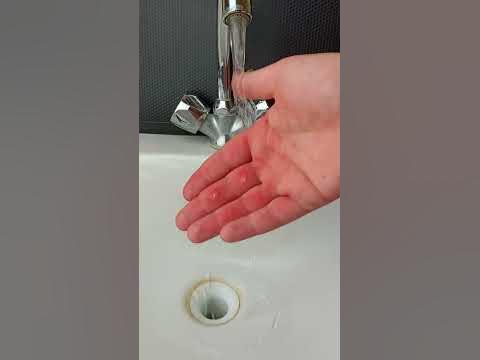 Как избавиться от ожога рук. Последствия ожога - YouTube