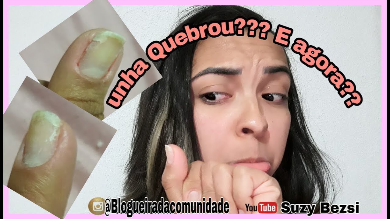 Unha quebrou na carne??? SUZY O QUE EU FAÇO????? - YouTube