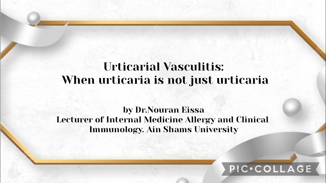 Urticarial Vasculitis When urticaria is not just urticaria,Dr Nouran Eissa Lecturer of Allergy&Immun