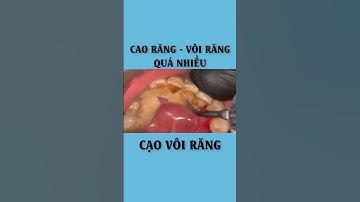 Lấy Cao Răng, Vôi Răng Quá Nhiều
