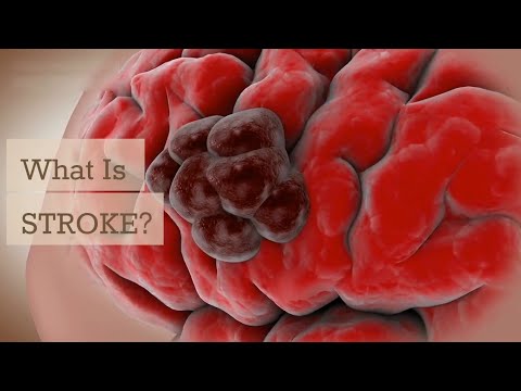 Understanding STROKE: Types, Symptoms, and Life-Saving Awareness