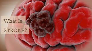 Understanding STROKE: Types, Symptoms, and Life-Saving Awareness
