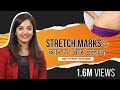 स्ट्रेच मार्क्स के कारण और इलाज | How to Get Rid of Stretch Marks