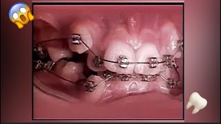 2 Years Of Braces In 20 Seconds- Braces Timelapse 